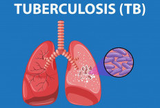 4 Warga Meninggal Akibat TB Paru, Segini Jumlah Penderitanya di Rejang Lebong