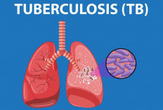 Kasus TB di Rejang Lebong Berpotensi Terus Bertambah