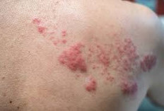 Apa Itu Penyakit Herpes Dipunggung dan Cara Pengobatannya 