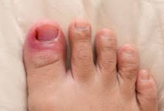 Jari Kaki Bengkak dan Berbagai Penyebabnya