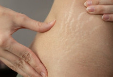Cara Menghilangkan Stretch Mark secara Alami