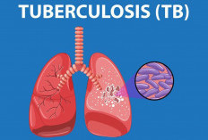 Lebong Utara Tertinggi Kasus TB Paru