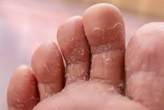 Yuk Ketahui Penyebab Kulit Jari Kaki Mengelupas