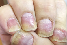 Kenali Berbagai Gejala Psoriasis Kuku